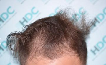 Dr. Maras at HDC clinic in Cyprus, 2400 FUE grafts class NW3, age 25