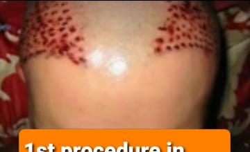 11 years since FUE repair procedure by HDC clinic in Cyprus back in 2009, still stands with 2500 grafts