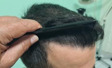 Hair Transplant Result – 3475 Grafts – Class 4 – HDC Hair Clinic – Dr Cristina