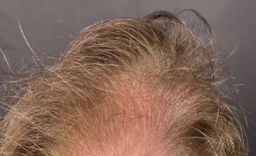 Dr. Arocha | 2016 Graft FUE Procedure