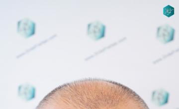 Dr. Rafael de Freitas - 4646 Grafts - 8946 Hairs