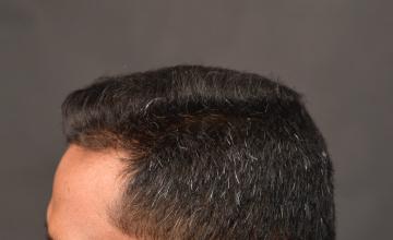 Dr. Arocha | 8 month results | 2000 FUE