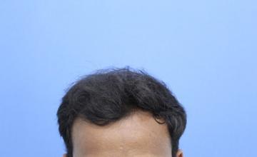 Dr. Kapil dua | 1515 Grafts by Bio FUE Technique | 12 Months Result