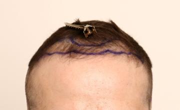 Dr. Robert Dorin ~ 1514 Graft FUE ~ 11 month progress