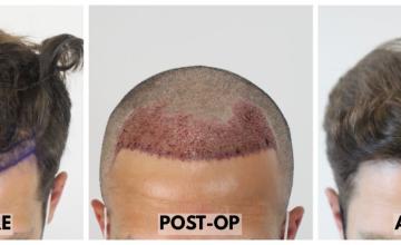 2520 Grafts (5224 Hairs) - FUE Hair Transplant - Dr. Rahal