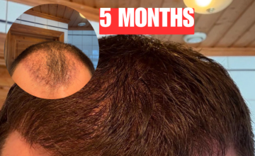 My hair transplant journey done by Dr Emil George in Norway mid January 2025, 2500 grafts in front and crown