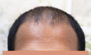 Dr. Timothy Carman- 2423 FU grafts; 15 Months PostOp