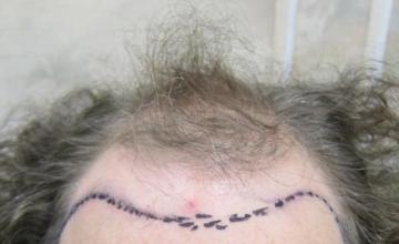 Dr. Timothy Carman- 3088 Total FU grafts; One year Post Op Result