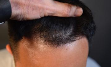 Dr. Arocha | 1800 Graft FUE | 4 month update