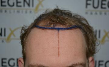 Dr. Munib Ahmad - 2480g Soft Dense Hairline - Light Blond Wavy Hair - FueGenix - The Netherlands