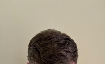 Dr Noosh (Nirush) 4700 Grafts 12,000 Hairs 6 months post
