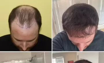 Dr Zarev - 6850 Grafts - January 27th, 2025 (currently no medication - 2,300 grafts upcoming) - 41 years old