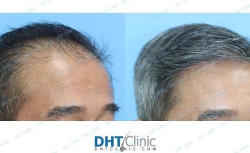 Dr. Damkerng Pathomvanich (DHT Clinic) / FUT+FUE 1,824 grafts, 1 year 3 months post op