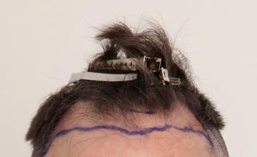 Dr. Robert Dorin ~ 2001 Grafts FUE ~ 11 months