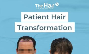 FUE 2870 - Dr Arshad - 9 month result.