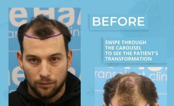 The Hair Dr (LEEDS, UK) Dr Arshad FRCS - FUE 9 month result