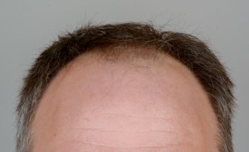 Robert Haber, MD - 1662  grafts FUT, Front and midscalp - 6 months