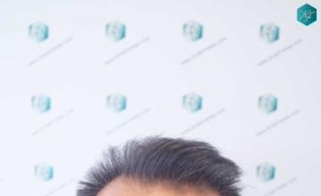 Dr. Rafael de Freitas - 5326 Grafts - 13.645 - Diffuse alopecia