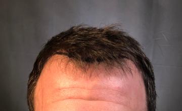 Dr. Arocha | 2500 graft FUE - 2 year results