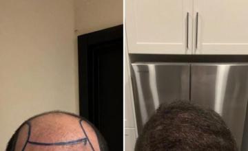 Surgery with Dr. Pittella (29yo)- 13,022 grafts