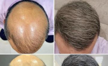 Dr. Felipe Pittella FUE/12,413 grafts/Oct 3rd and 4th, 2024