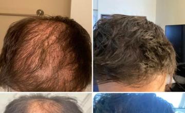 Dr. Sean Benham: 6,185 Grafts (500 beard), 2-day FUE procedure. It's nice to be #1 at something....