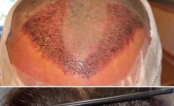 My hairtransplant journey- Dr. Emil George surgery done in Norway in the end of january this year