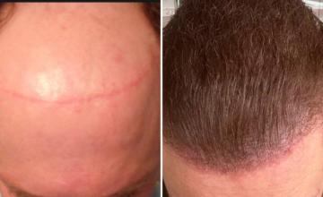 GATSBY 'UNPLUGGED!' 14,468 (2 surgeries) Grafts FUE+BHT Dr. Sethi Eugenix