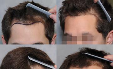 Dr. Arocha | 2000 Graft FUT Procedure