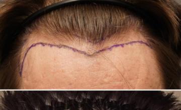 1500 Graft Hairline FUE with Dr. Laorwong (4 Months)