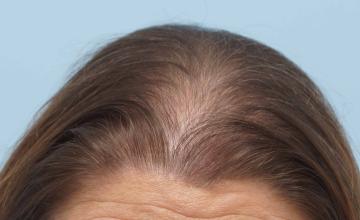 Dr B Farjo 1400g FUT frontal