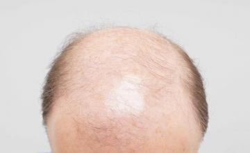 Dr B Farjo 3800g via FUT on lower than average hair quality patient over two procedures.