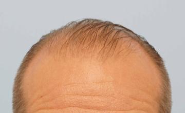 Dr B Farjo 1700g FUE (Front)