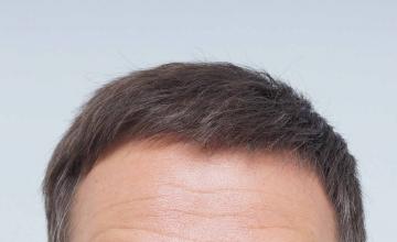 Dr B Farjo 1800g FUE