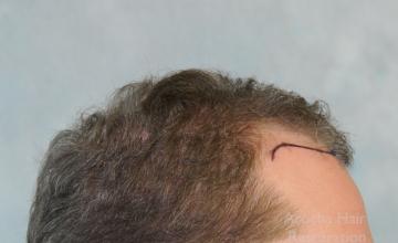 Dr. Arocha | 3000 graft FUT Procedure