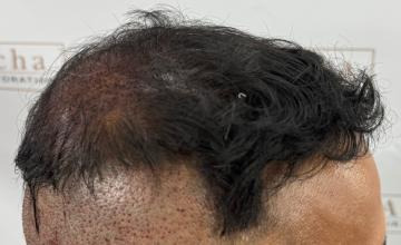 Dr. Arocha | 2710 graft FUE | Early Results