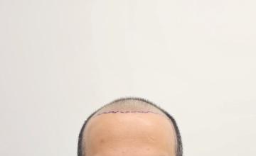 6100 Grafts - Dr Ruk norwood 6