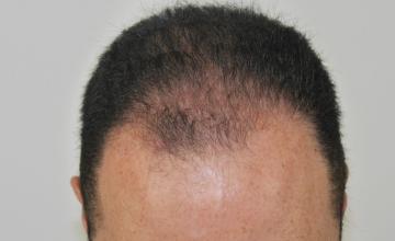 Dr. Glenn M. Charles FUT procedure