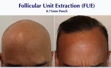 From Bald to #BAM! (2384 FUE grafts): Caros K. Wesley, MD (NYC & LA)