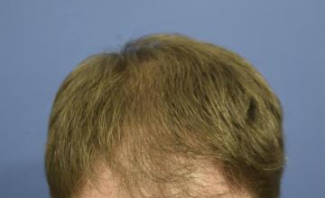 Dr Carman 1829 FU Grafts, Strip Excision; 9 Month FollowUp