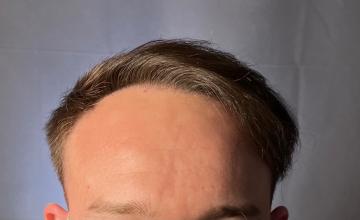 Dr. Arocha | 2500 Graft FUT+PRP | 8 Month Results