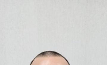 4863 Grafts INSANE result Dr RUK