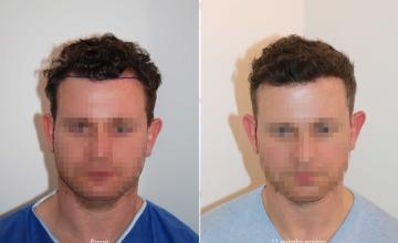 Case performed by Dr. Feriduni – 2653 FU in 1 procedure