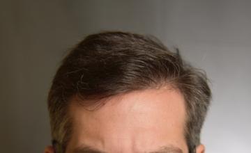 Dr. Arocha | 2000 FUE +PRP | ~2 year results