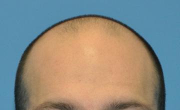 Michael Vories, MD 3000 FUE Grafts