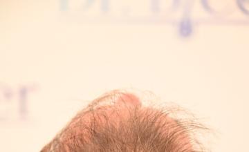 Ozlem Bicer MD-3840 Grafts FUE by micro-motor, 8. month result
