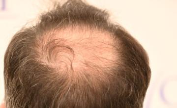 Ozlem Bicer MD-Hair Transplant-3870 Grafts FUE by micro-motor, 5. months result