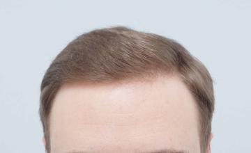 Dr B Farjo 2200g FUE to crown and hairline tweak.