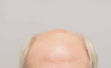 Dr B Farjo 5000g via FUT on fine hair patient.