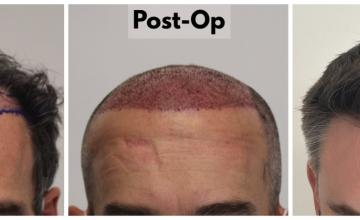 2180 Grafts (4830 Hairs) - FUE Hair Transplant - Dr. Rahal